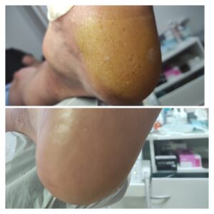 pięta popękana, Usuwanie odcisków – podolog Wisła Leczenie wrastających paznokci – podolog Wisła Specjalistyczna pomoc podologiczna w Wiśle