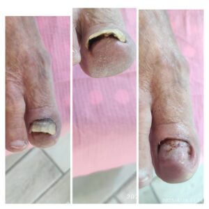 Usuwanie odcisków – podolog Wisła Leczenie wrastających paznokci – podolog Wisła Specjalistyczna pomoc podologiczna w Wiśle