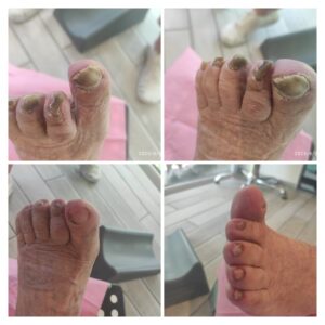 Zdrowe stopy po zabiegu u podologa w Wiśle Pielęgnacja stóp wykonana przez podologa w Wiśle Efekt zabiegu podologicznego – gabinet podologiczny Wisła