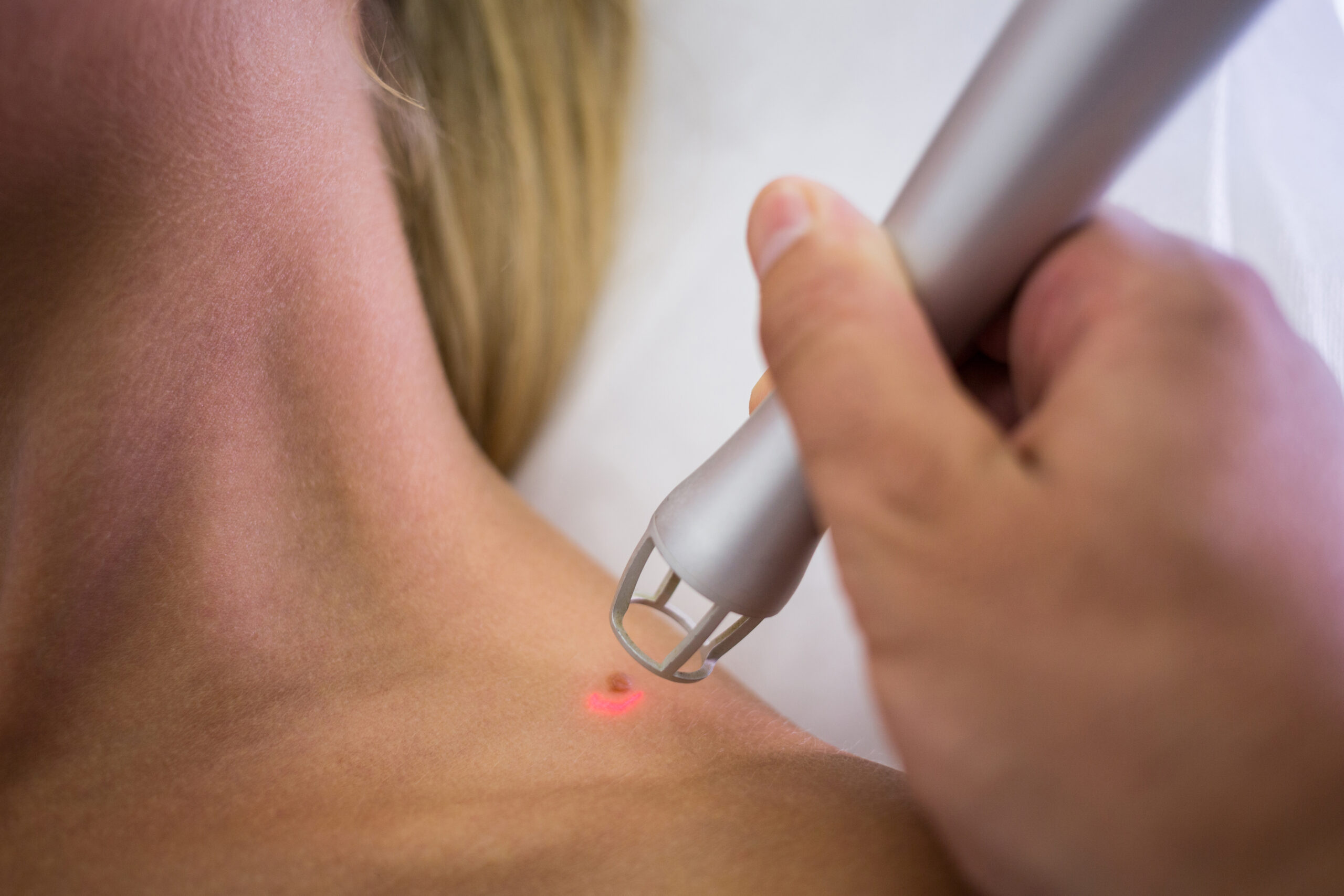 Terapia zmian skórnych i laseroterapia – podolog Wisła